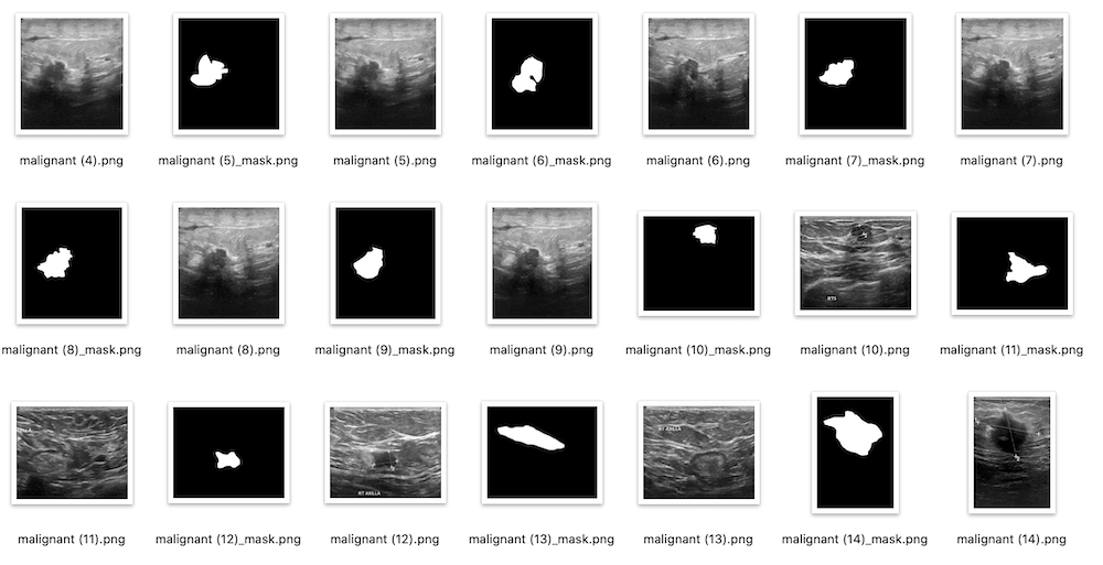 乳腺癌超声图像数据集-Breast Ultrasound Images Dataset