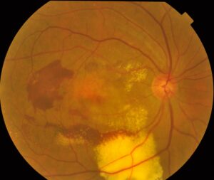 1000 张眼底图像，39 个类别-1000 Fundus images with 39 categories