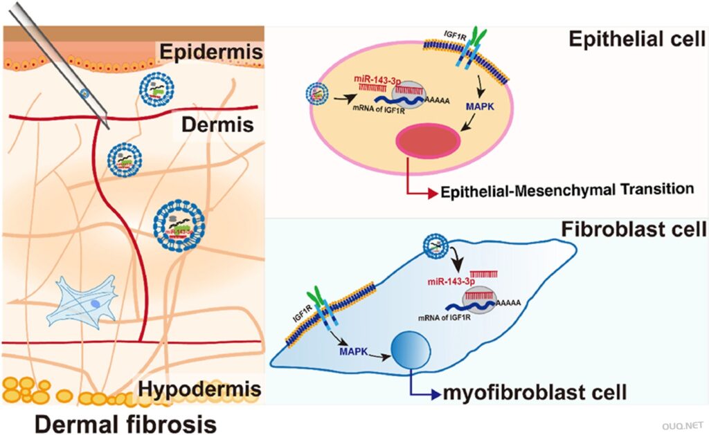 外泌体治疗硬皮病研究进展：miR-143-3p boosts extracellular vesicles to improve the dermal fibrosis of localized scleroderma